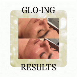 Glo2Facial Treatment Before and After